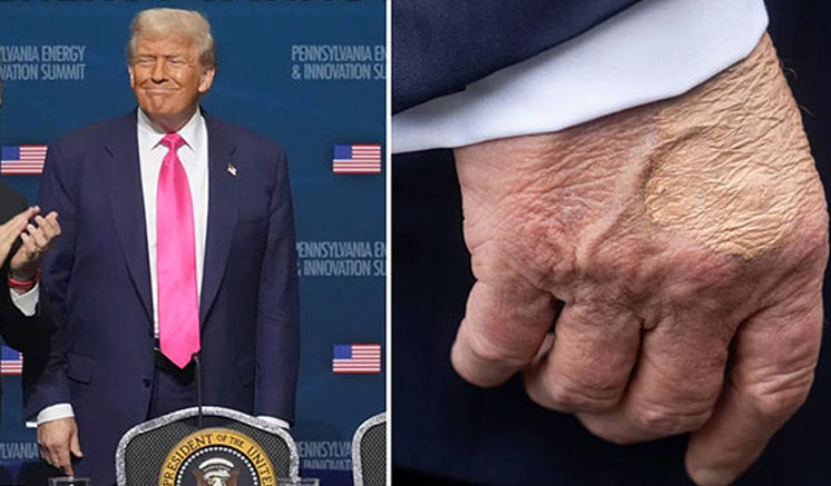 White House says Trump diagnosed with vein condition after questions about bruises